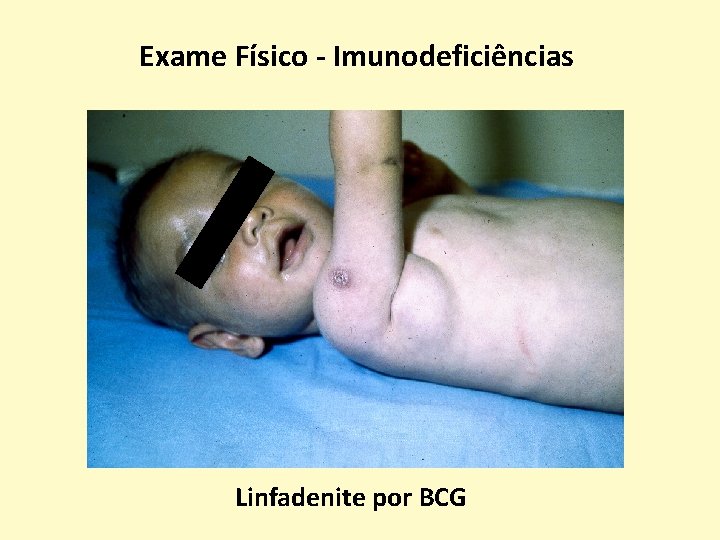 Exame Físico - Imunodeficiências Linfadenite por BCG 