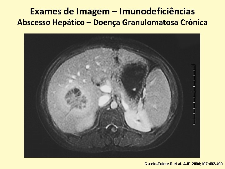 Exames de Imagem – Imunodeficiências Abscesso Hepático – Doença Granulomatosa Crônica Garcia-Eulate R et