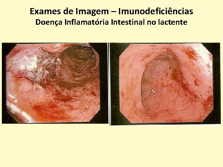 Exames de Imagem – Imunodeficiências Doença Inflamatória Intestinal no lactente 