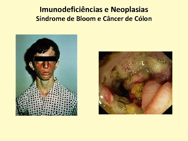 Imunodeficiências e Neoplasias Síndrome de Bloom e Câncer de Cólon 