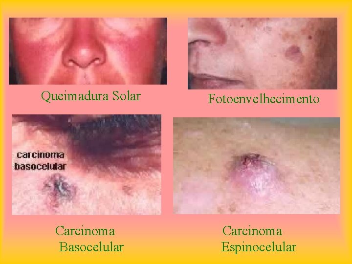 Queimadura Solar Carcinoma Basocelular Fotoenvelhecimento Carcinoma Espinocelular 
