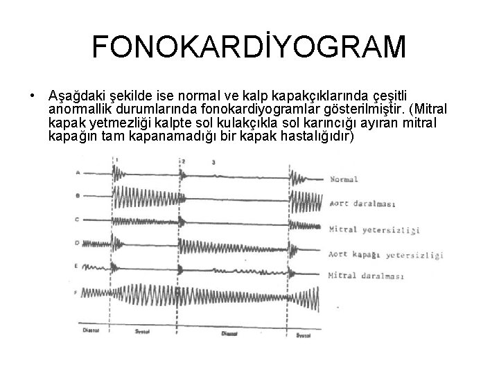 FONOKARDİYOGRAM • Aşağdaki şekilde ise normal ve kalp kapakçıklarında çeşitli anormallik durumlarında fonokardiyogramlar gösterilmiştir.