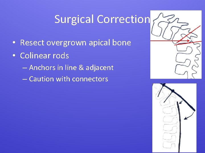 Surgical Correction • Resect overgrown apical bone • Colinear rods – Anchors in line