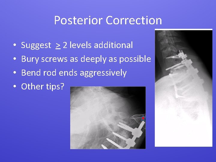 Posterior Correction • • Suggest > 2 levels additional Bury screws as deeply as