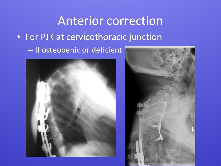 Anterior correction • For PJK at cervicothoracic junction – If osteopenic or deficient 