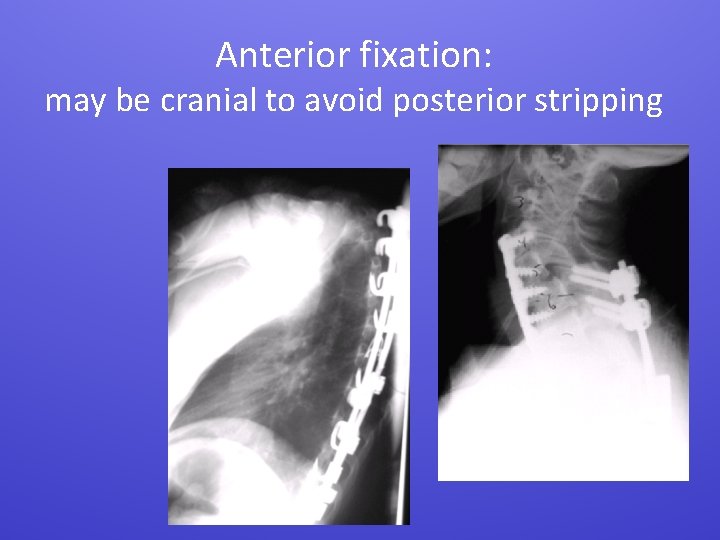 Anterior fixation: may be cranial to avoid posterior stripping 