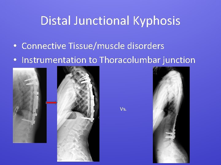 Distal Junctional Kyphosis • Connective Tissue/muscle disorders • Instrumentation to Thoracolumbar junction Vs. 