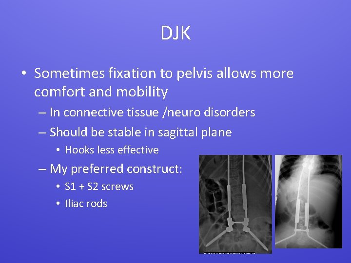 DJK • Sometimes fixation to pelvis allows more comfort and mobility – In connective