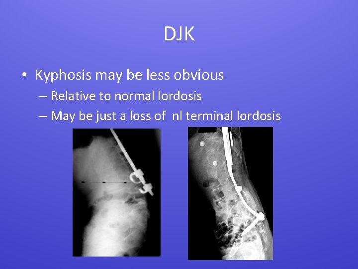 DJK • Kyphosis may be less obvious – Relative to normal lordosis – May