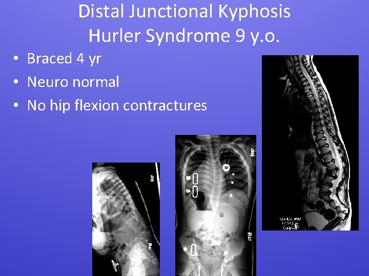 Distal Junctional Kyphosis Hurler Syndrome 9 y. o. • Braced 4 yr • Neuro
