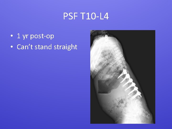 PSF T 10 -L 4 • 1 yr post-op • Can’t stand straight 