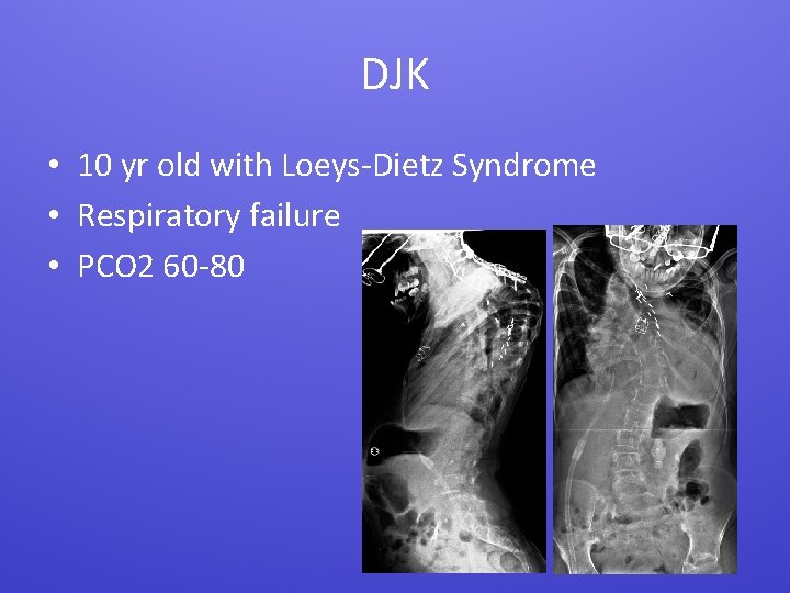 DJK • 10 yr old with Loeys-Dietz Syndrome • Respiratory failure • PCO 2