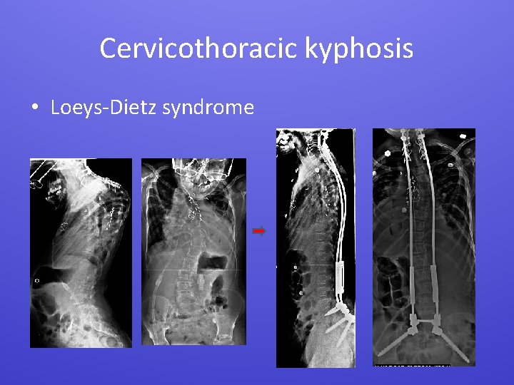 Cervicothoracic kyphosis • Loeys-Dietz syndrome 