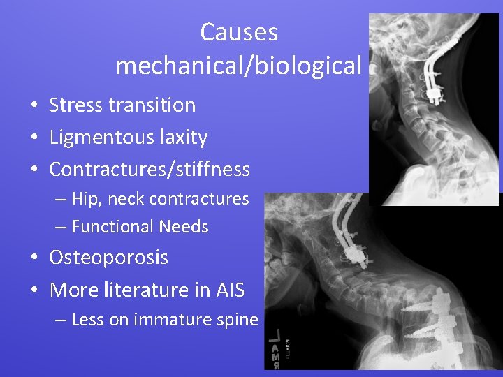 Causes mechanical/biological • Stress transition • Ligmentous laxity • Contractures/stiffness – Hip, neck contractures
