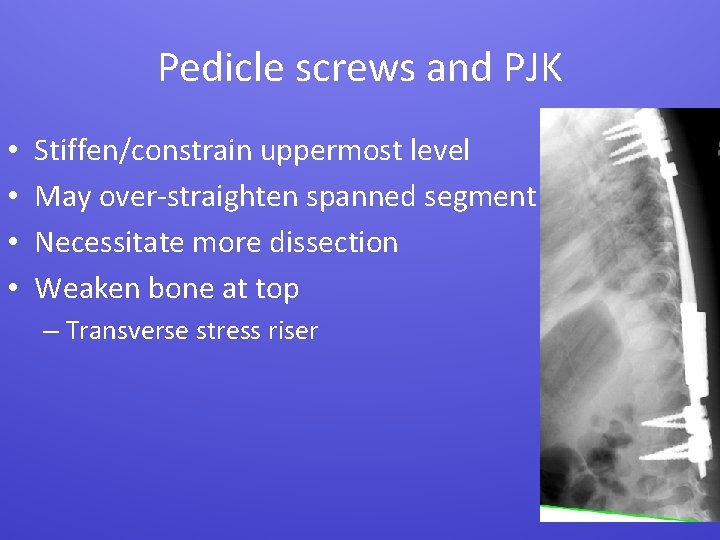 Pedicle screws and PJK • • Stiffen/constrain uppermost level May over-straighten spanned segment Necessitate