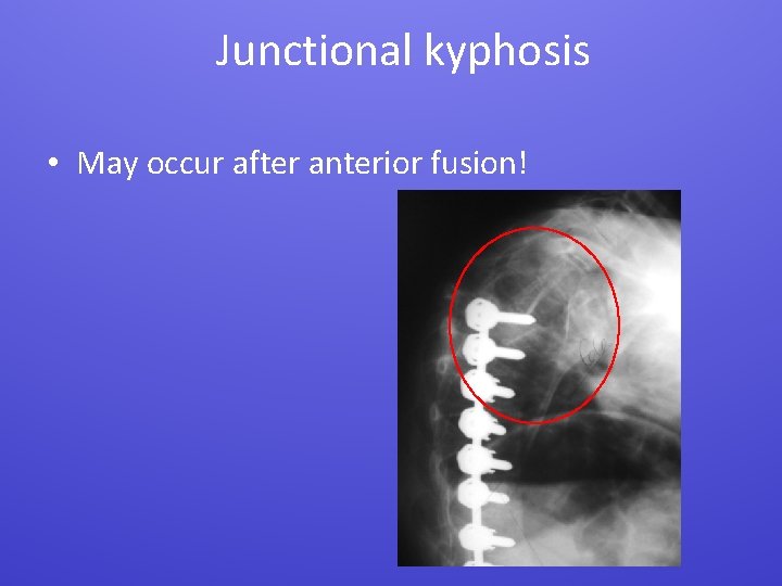 Junctional kyphosis • May occur after anterior fusion! 