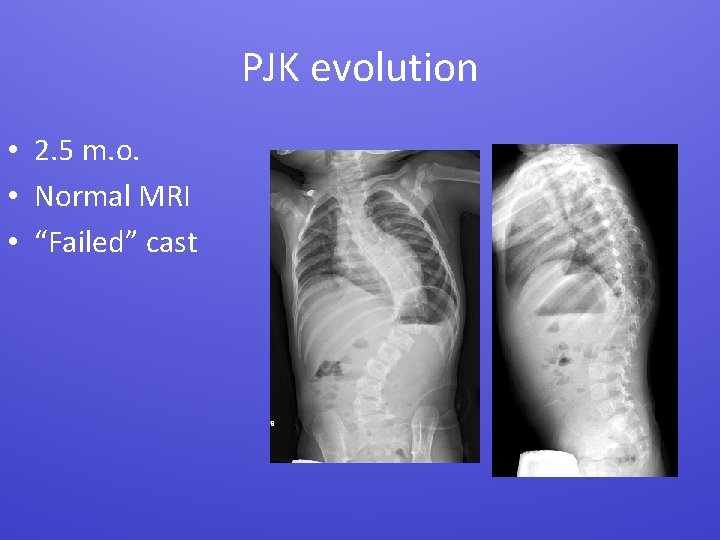 PJK evolution • 2. 5 m. o. • Normal MRI • “Failed” cast 