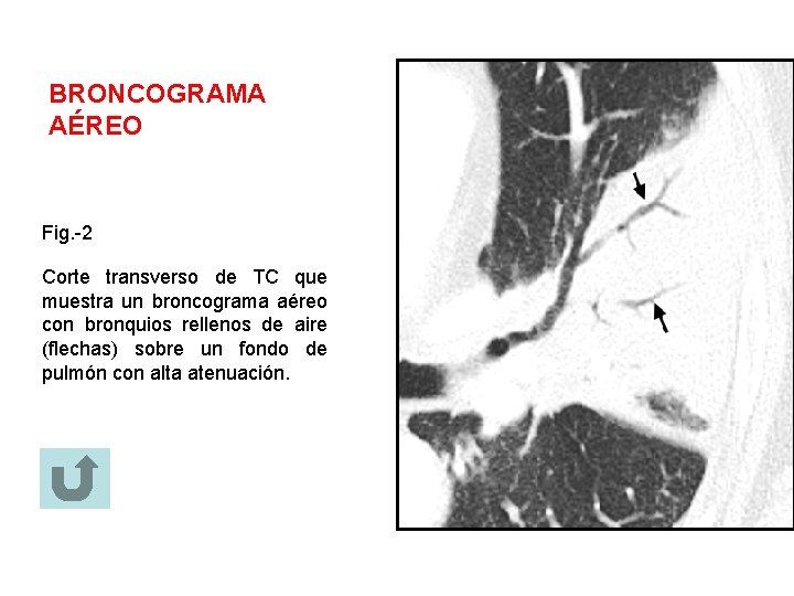 BRONCOGRAMA AÉREO Fig. -2 Corte transverso de TC que muestra un broncograma aéreo con