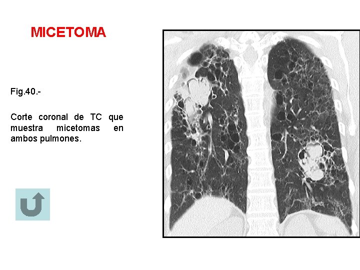 MICETOMA Fig. 40. Corte coronal de TC que muestra micetomas en ambos pulmones. 