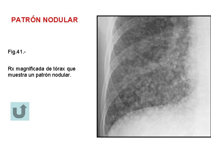 PATRÓN NODULAR Fig. 41. Rx magnificada de tórax que muestra un patrón nodular. 