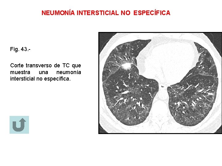 NEUMONÍA INTERSTICIAL NO ESPECÍFICA Fig. 43. Corte transverso de TC que muestra una neumonía