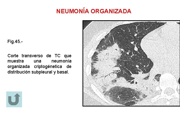 NEUMONÍA ORGANIZADA Fig. 45. Corte transverso de TC que muestra una neumonía organizada criptogénetica