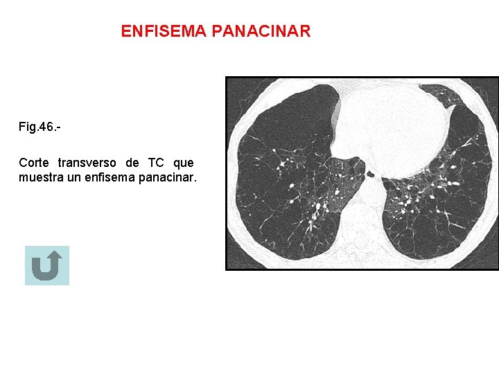 ENFISEMA PANACINAR Fig. 46. Corte transverso de TC que muestra un enfisema panacinar. 