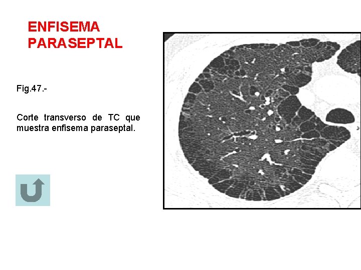 ENFISEMA PARASEPTAL Fig. 47. Corte transverso de TC que muestra enfisema paraseptal. 