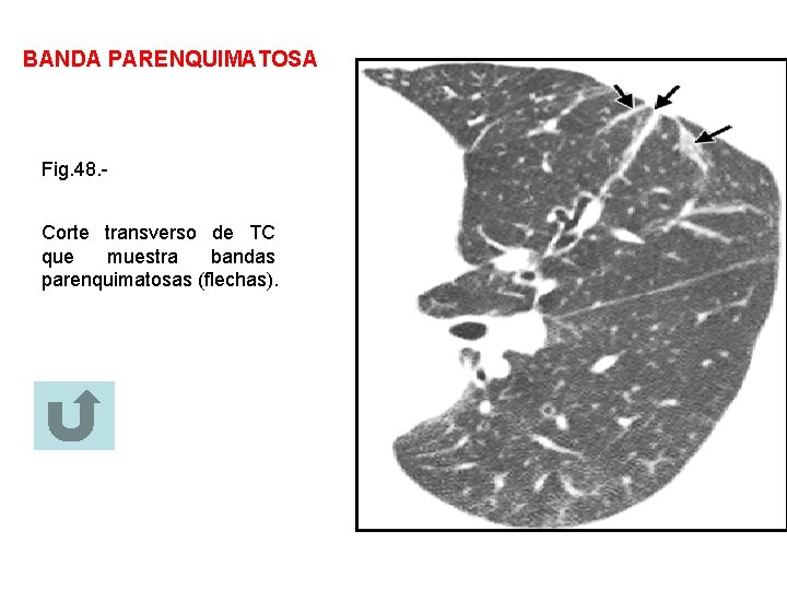 BANDA PARENQUIMATOSA Fig. 48. Corte transverso de TC que muestra bandas parenquimatosas (flechas). 