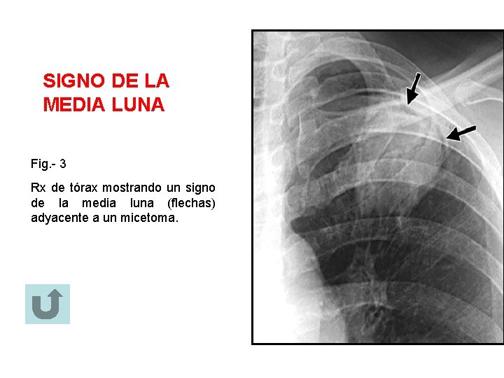 SIGNO DE LA MEDIA LUNA Fig. - 3 Rx de tórax mostrando un signo