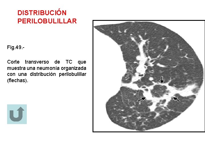 DISTRIBUCIÓN PERILOBULILLAR Fig. 49. Corte transverso de TC que muestra una neumonía organizada con