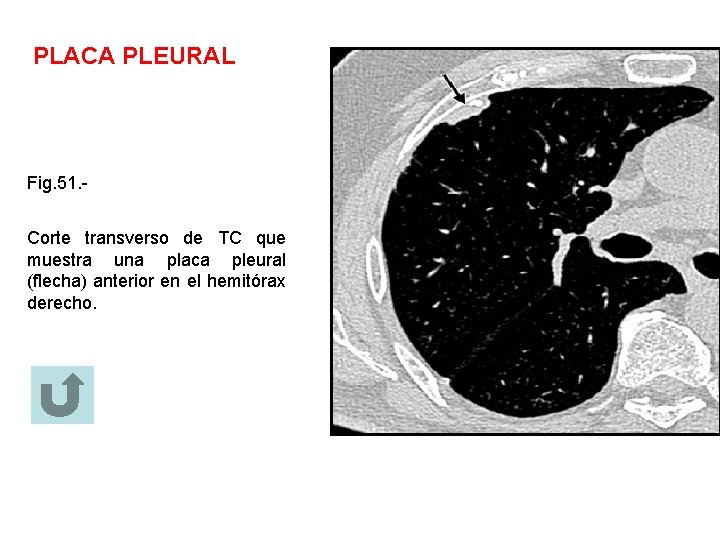 PLACA PLEURAL Fig. 51. Corte transverso de TC que muestra una placa pleural (flecha)