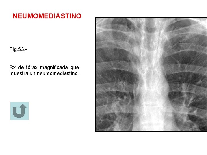 NEUMOMEDIASTINO Fig. 53. Rx de tórax magnificada que muestra un neumomediastino. 