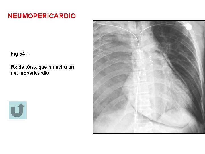 NEUMOPERICARDIO Fig. 54. Rx de tórax que muestra un neumopericardio. 