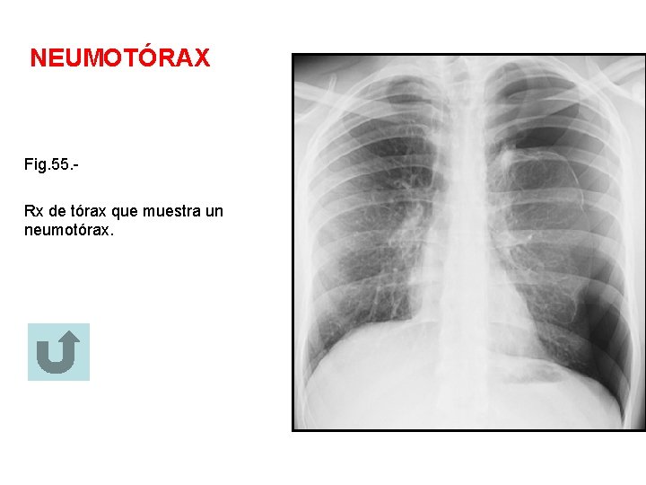 NEUMOTÓRAX Fig. 55. Rx de tórax que muestra un neumotórax. 