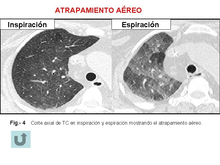 ATRAPAMIENTO AÉREO Inspiración Espiración Fig. - 4 Corte axial de TC en inspiración y