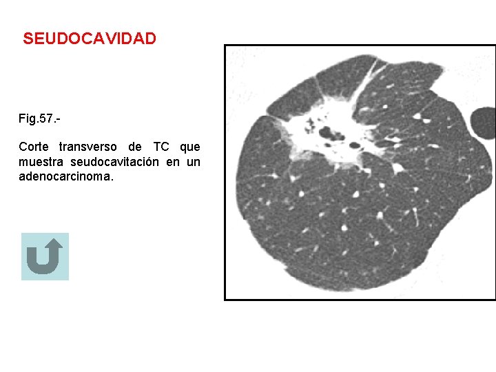 SEUDOCAVIDAD Fig. 57. Corte transverso de TC que muestra seudocavitación en un adenocarcinoma. 