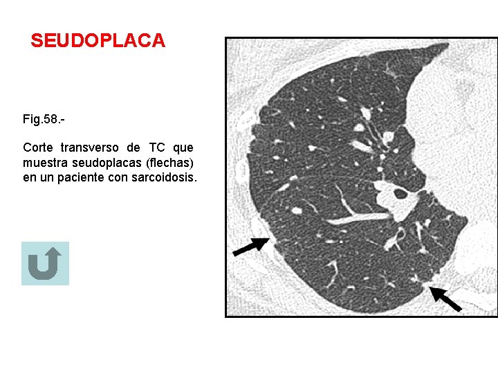 SEUDOPLACA Fig. 58. Corte transverso de TC que muestra seudoplacas (flechas) en un paciente