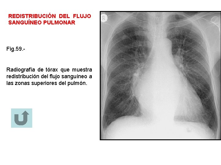 REDISTRIBUCIÓN DEL FLUJO SANGUÍNEO PULMONAR Fig. 59. - Radiografía de tórax que muestra redistribución