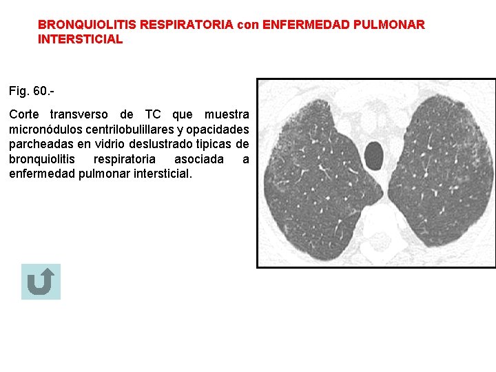 BRONQUIOLITIS RESPIRATORIA con ENFERMEDAD PULMONAR INTERSTICIAL Fig. 60. Corte transverso de TC que muestra