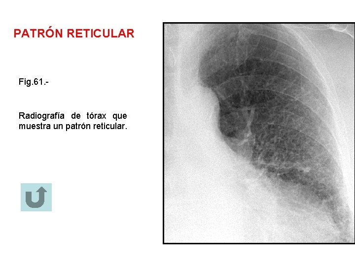 PATRÓN RETICULAR Fig. 61. - Radiografía de tórax que muestra un patrón reticular. 