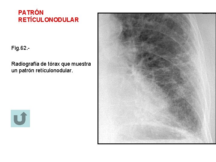 PATRÓN RETÍCULONODULAR Fig. 62. Radiografía de tórax que muestra un patrón retículonodular. 