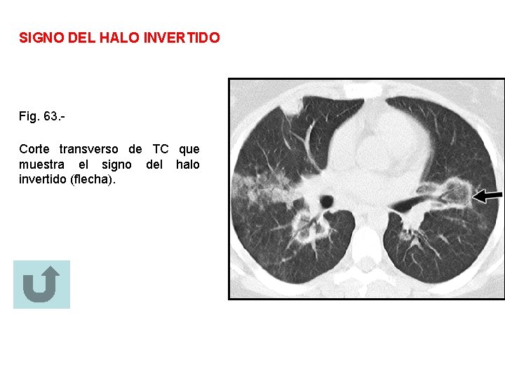 SIGNO DEL HALO INVERTIDO Fig. 63. Corte transverso de TC que muestra el signo