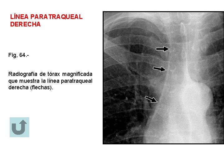 LÍNEA PARATRAQUEAL DERECHA Fig, 64. Radiografía de tórax magnificada que muestra la línea paratraqueal