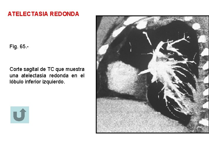 ATELECTASIA REDONDA Fig. 65. - Corte sagital de TC que muestra una atelectasia redonda