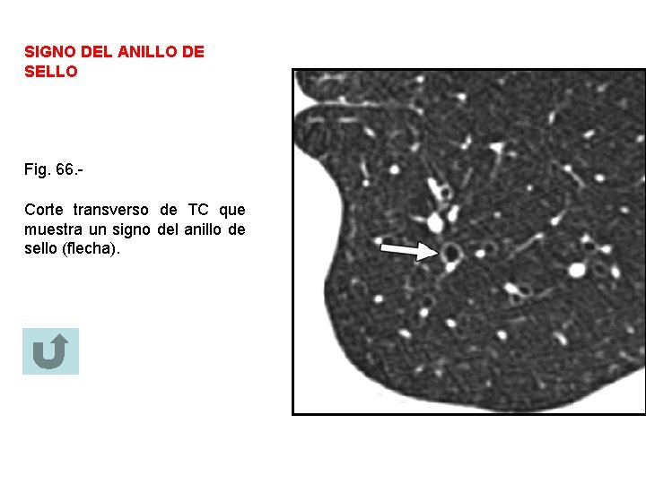 SIGNO DEL ANILLO DE SELLO Fig. 66. Corte transverso de TC que muestra un