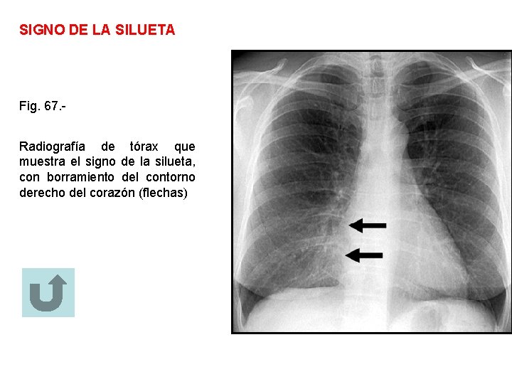 SIGNO DE LA SILUETA Fig. 67. Radiografía de tórax que muestra el signo de