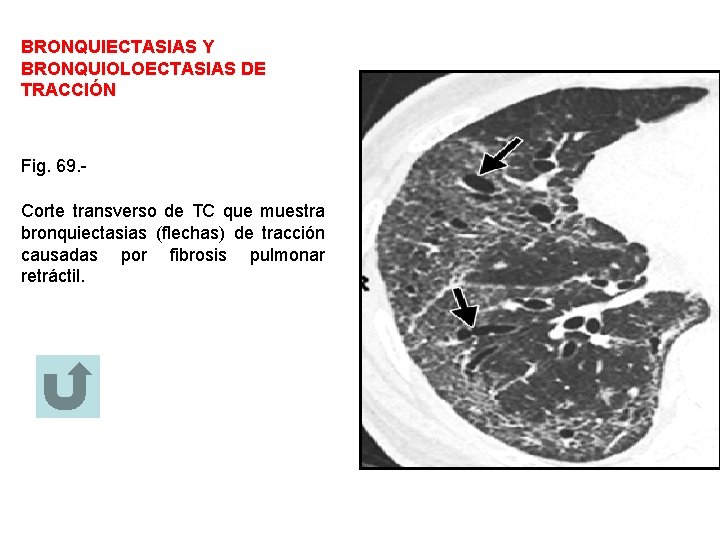BRONQUIECTASIAS Y BRONQUIOLOECTASIAS DE TRACCIÓN Fig. 69. Corte transverso de TC que muestra bronquiectasias