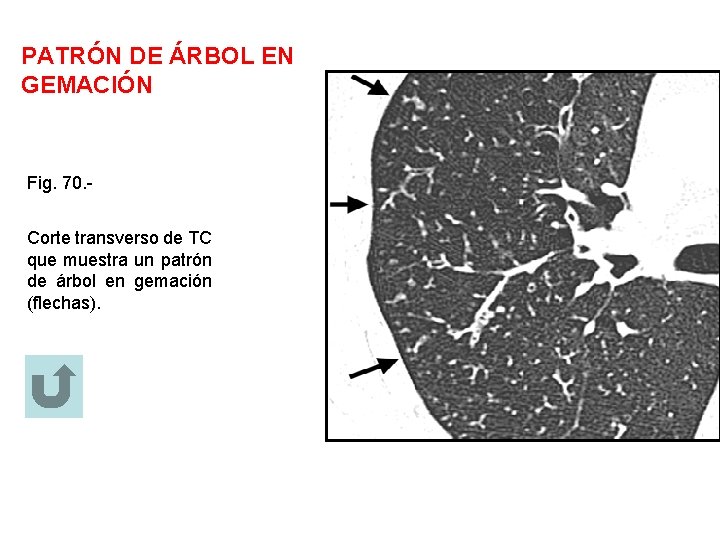 PATRÓN DE ÁRBOL EN GEMACIÓN Fig. 70. Corte transverso de TC que muestra un