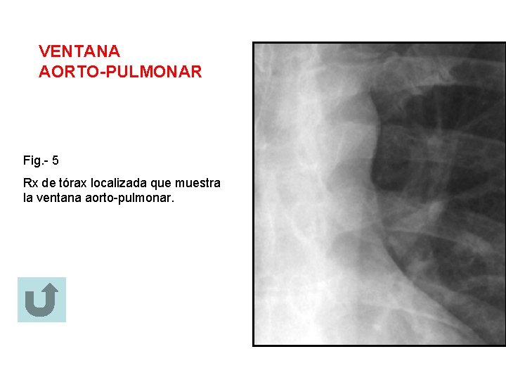 VENTANA AORTO-PULMONAR Fig. - 5 Rx de tórax localizada que muestra la ventana aorto-pulmonar.